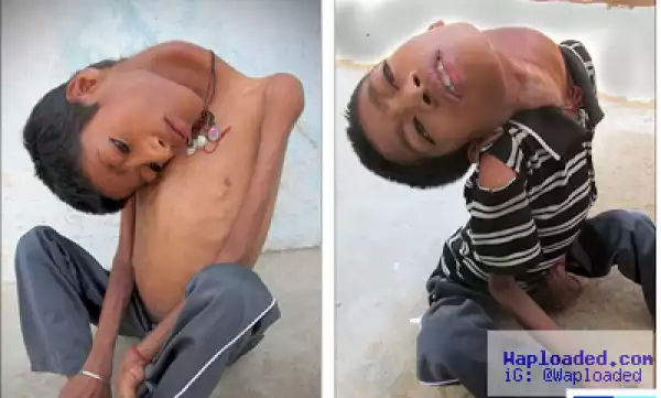 Indian boy whose head hung upside down undergoes life changing surgery (photos)